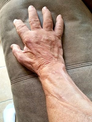 Terry Vandeventer arm showing snake bite